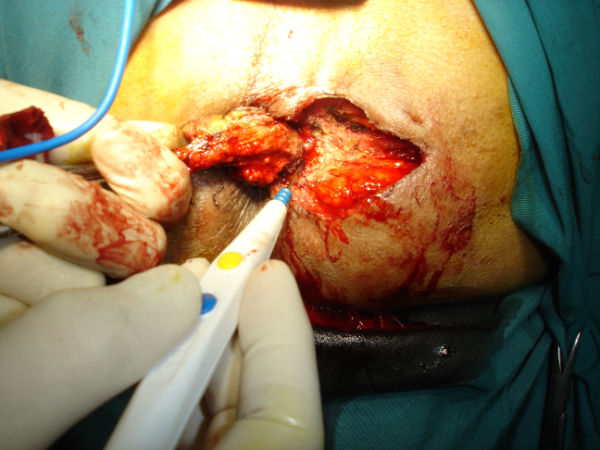remove anal fistula in operation room ( surgery treatment )